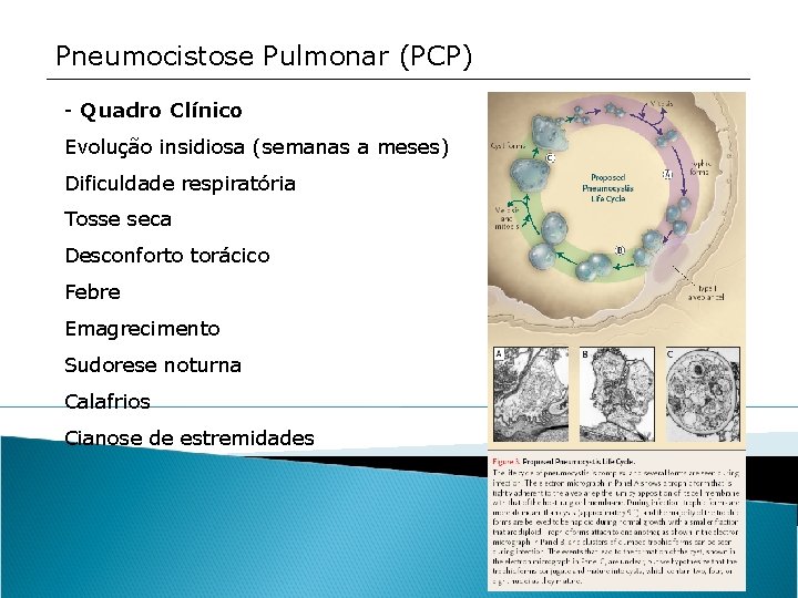 Pneumocistose Pulmonar (PCP) - Quadro Clínico Evolução insidiosa (semanas a meses) Dificuldade respiratória Tosse