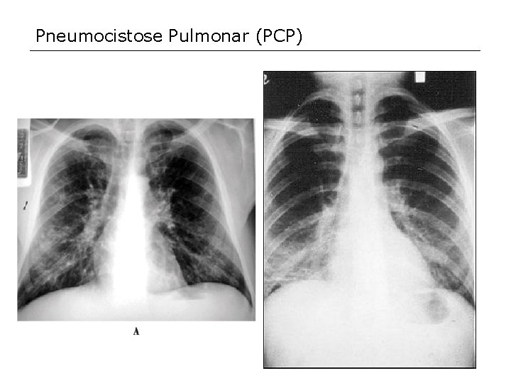 Pneumocistose Pulmonar (PCP) 