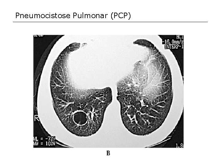 Pneumocistose Pulmonar (PCP) 