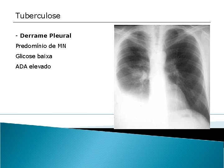 Tuberculose - Derrame Pleural Predomínio de MN Glicose baixa ADA elevado 