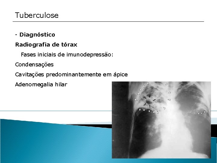 Tuberculose - Diagnóstico Radiografia de tórax Fases iniciais de imunodepressão: Condensações Cavitações predominantemente em