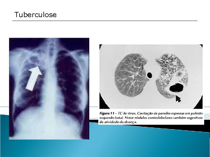 Tuberculose 