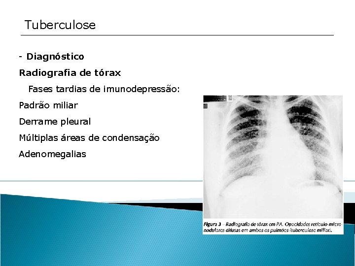 Tuberculose - Diagnóstico Radiografia de tórax Fases tardias de imunodepressão: Padrão miliar Derrame pleural