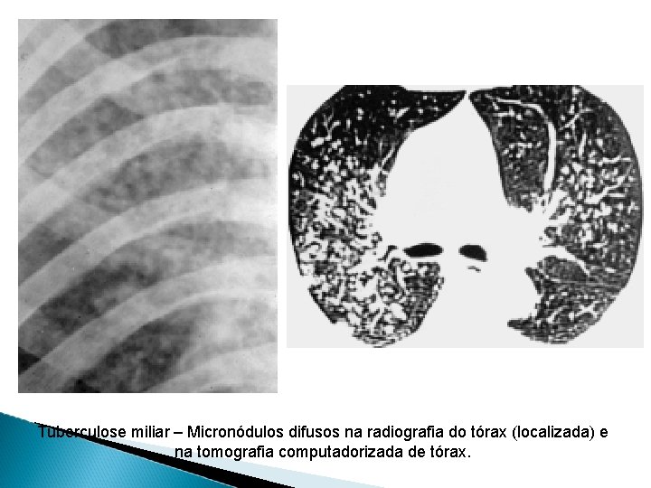 Tuberculose miliar – Micronódulos difusos na radiografia do tórax (localizada) e na tomografia computadorizada