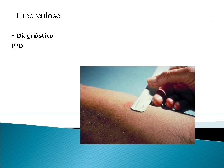 Tuberculose - Diagnóstico PPD 