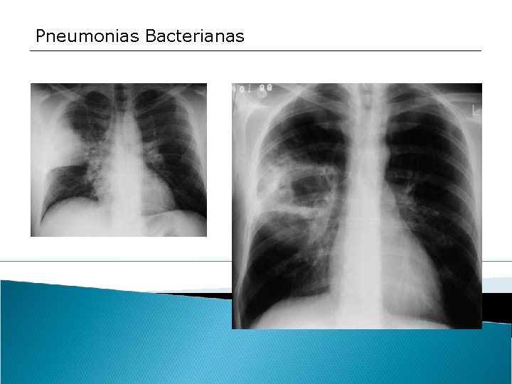 Pneumonias Bacterianas 
