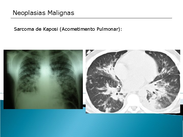 Neoplasias Malignas Sarcoma de Kaposi (Acometimento Pulmonar): 