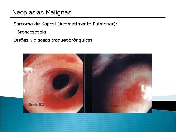 Neoplasias Malignas Sarcoma de Kaposi (Acometimento Pulmonar): - Broncoscopia Lesões violáceas traqueobrônquicas 