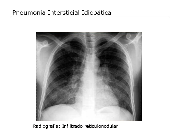 Pneumonia Intersticial Idiopática Radiografia: Infiltrado reticulonodular 