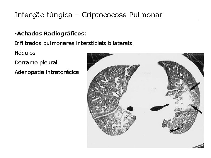 Infecção fúngica – Criptococose Pulmonar -Achados Radiográficos: Infiltrados pulmonares intersticiais bilaterais Nódulos Derrame pleural
