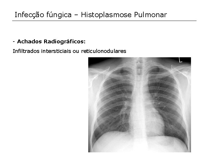 Infecção fúngica – Histoplasmose Pulmonar - Achados Radiográficos: Infiltrados intersticiais ou reticulonodulares 