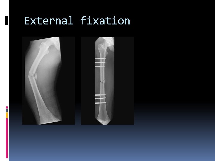 External fixation 