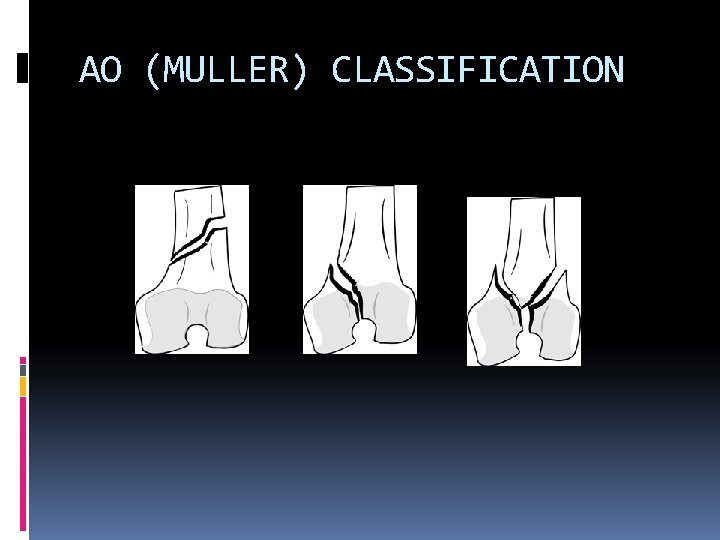 AO (MULLER) CLASSIFICATION 