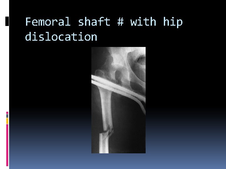 Femoral shaft # with hip dislocation 