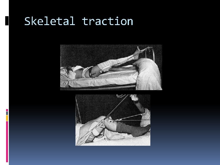 Skeletal traction 
