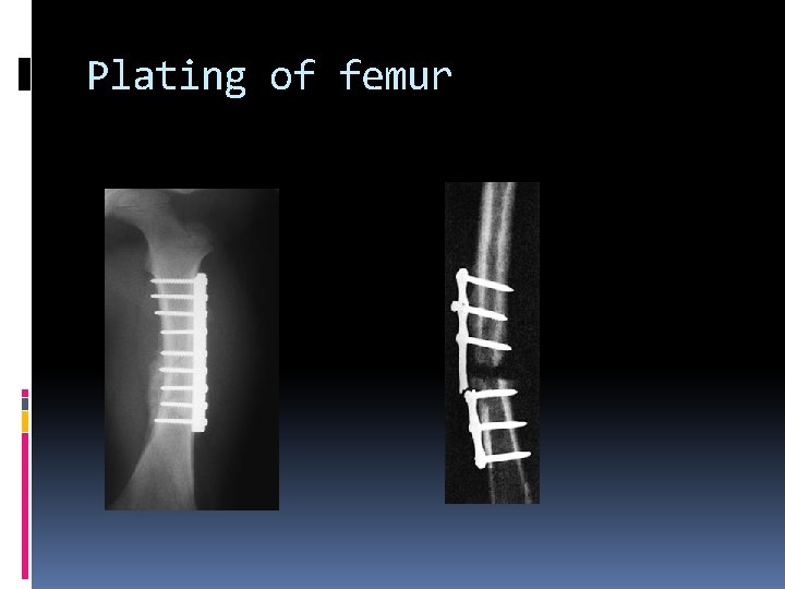 Plating of femur 