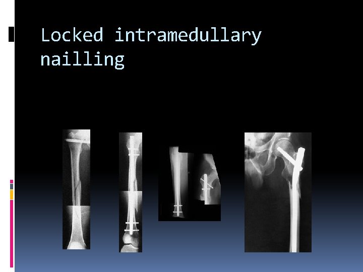 Locked intramedullary nailling 