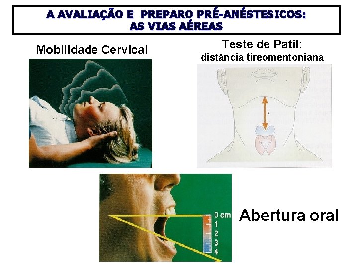 A AVALIAÇÃO E PREPARO PRÉ-ANÉSTESICOS: AS VIAS AÉREAS Mobilidade Cervical Teste de Patil: distância