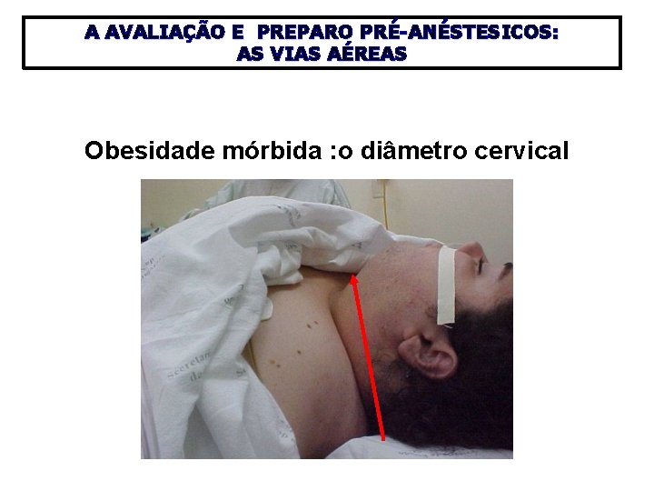 A AVALIAÇÃO E PREPARO PRÉ-ANÉSTESICOS: AS VIAS AÉREAS Obesidade mórbida : o diâmetro cervical