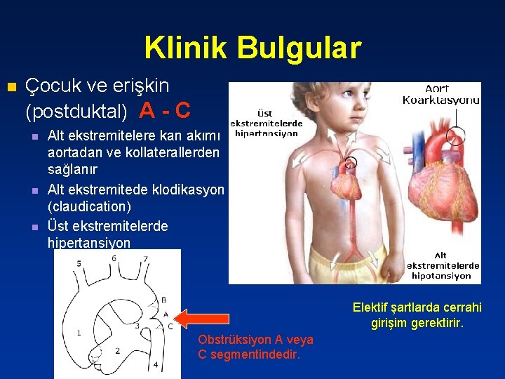 Klinik Bulgular n Çocuk ve erişkin (postduktal) A - C n n n Alt