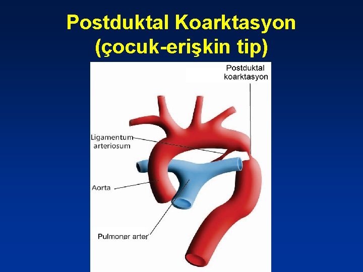 Postduktal Koarktasyon (çocuk-erişkin tip) 