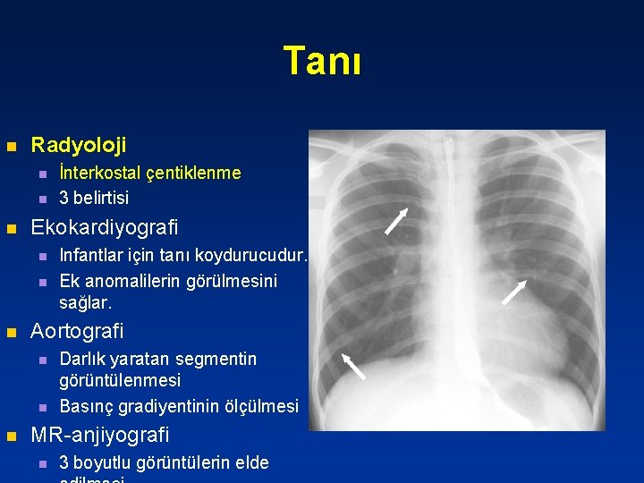 Tanı n Radyoloji n n n Ekokardiyografi n n n Infantlar için tanı koydurucudur.