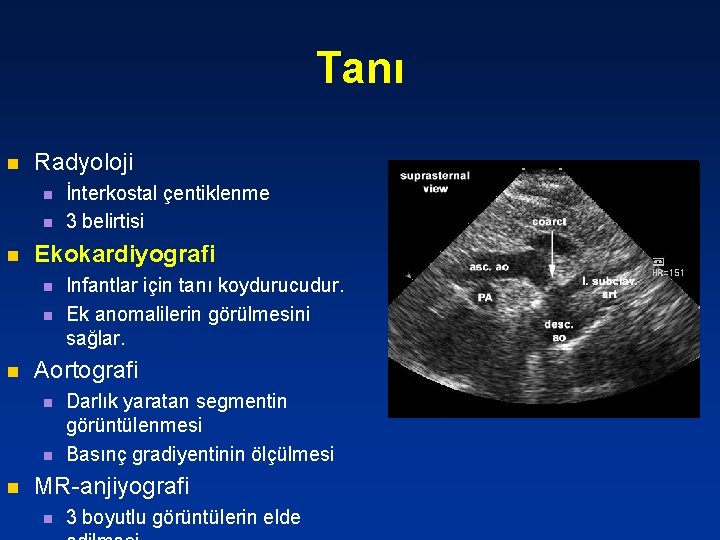 Tanı n Radyoloji n n n Ekokardiyografi n n n Infantlar için tanı koydurucudur.