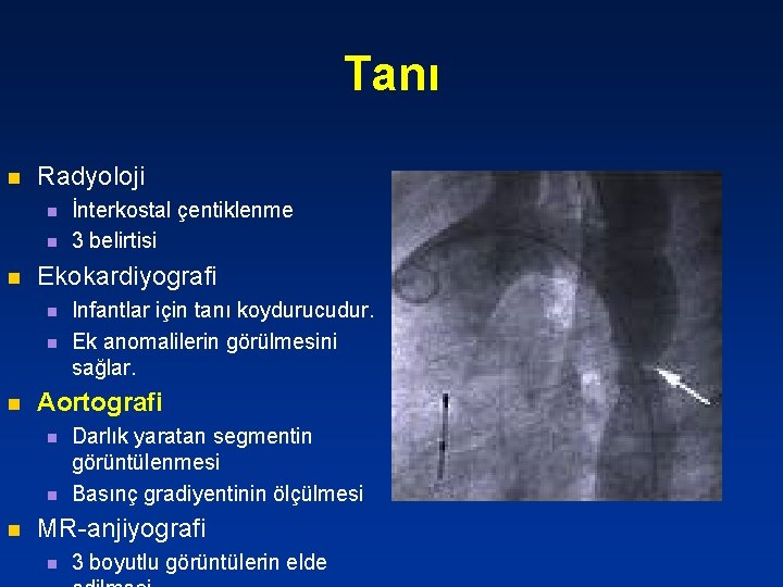 Tanı n Radyoloji n n n Ekokardiyografi n n n Infantlar için tanı koydurucudur.