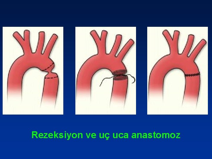 Rezeksiyon ve uç uca anastomoz 