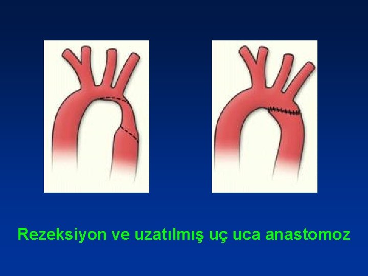 Rezeksiyon ve uzatılmış uç uca anastomoz 