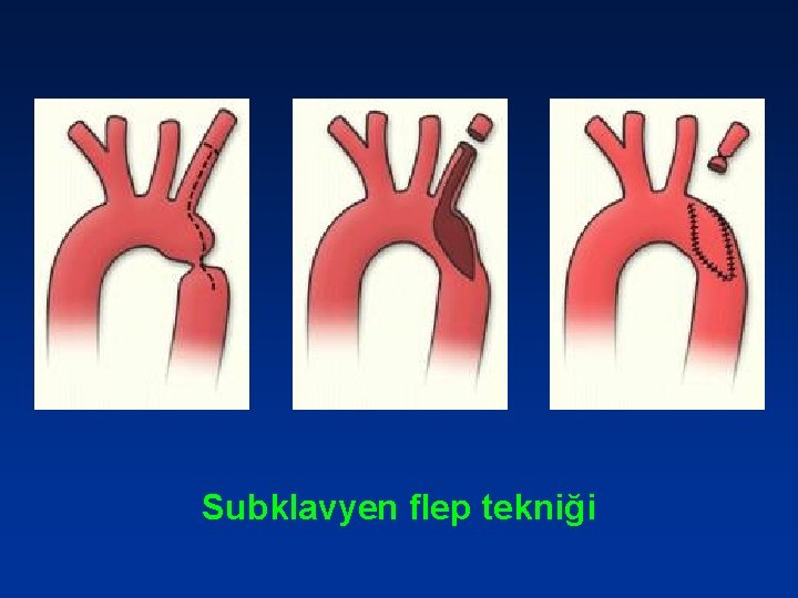 Subklavyen flep tekniği 