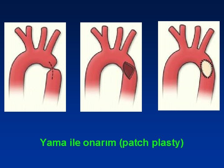 Yama ile onarım (patch plasty) 