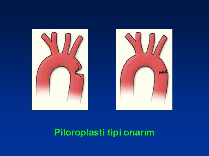 Piloroplasti tipi onarım 