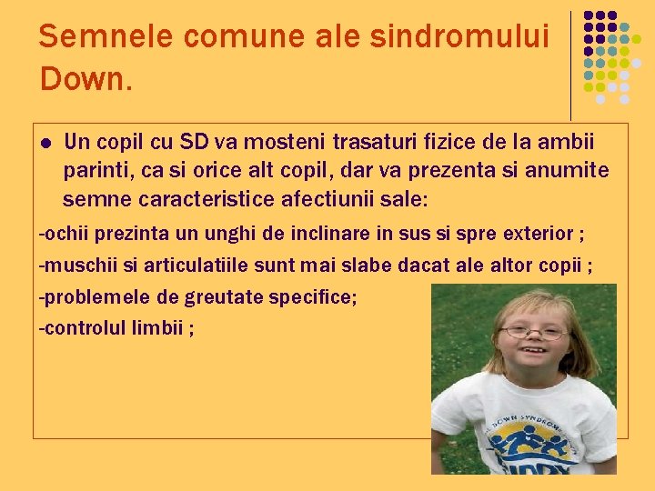 Semnele comune ale sindromului Down. l Un copil cu SD va mosteni trasaturi fizice