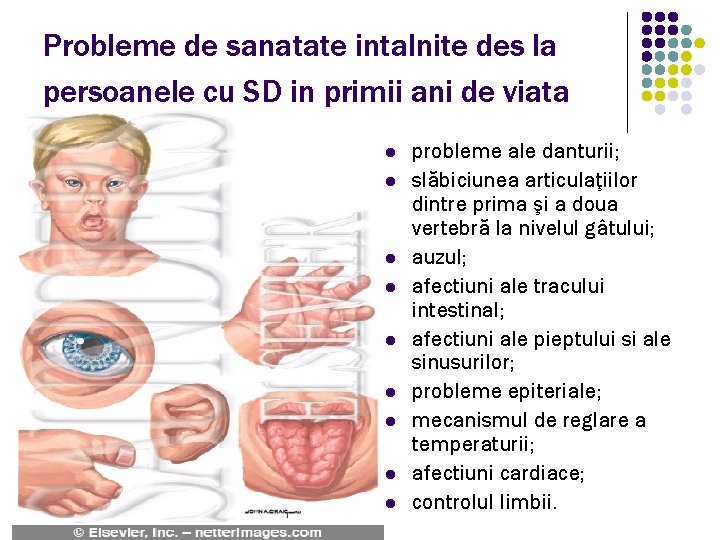 Probleme de sanatate intalnite des la persoanele cu SD in primii ani de viata