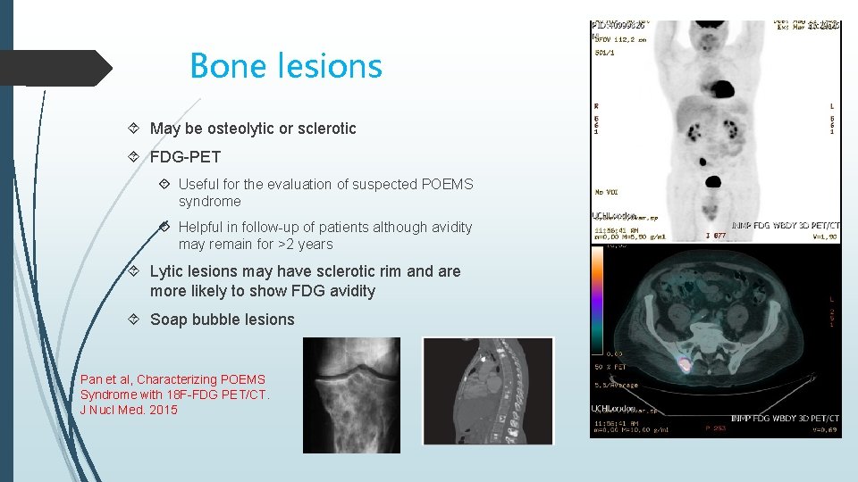 Bone lesions May be osteolytic or sclerotic FDG-PET Useful for the evaluation of suspected