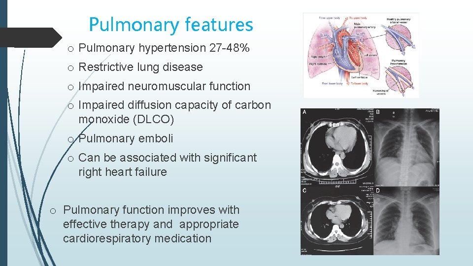Pulmonary features o Pulmonary hypertension 27 -48% o Restrictive lung disease o Impaired neuromuscular