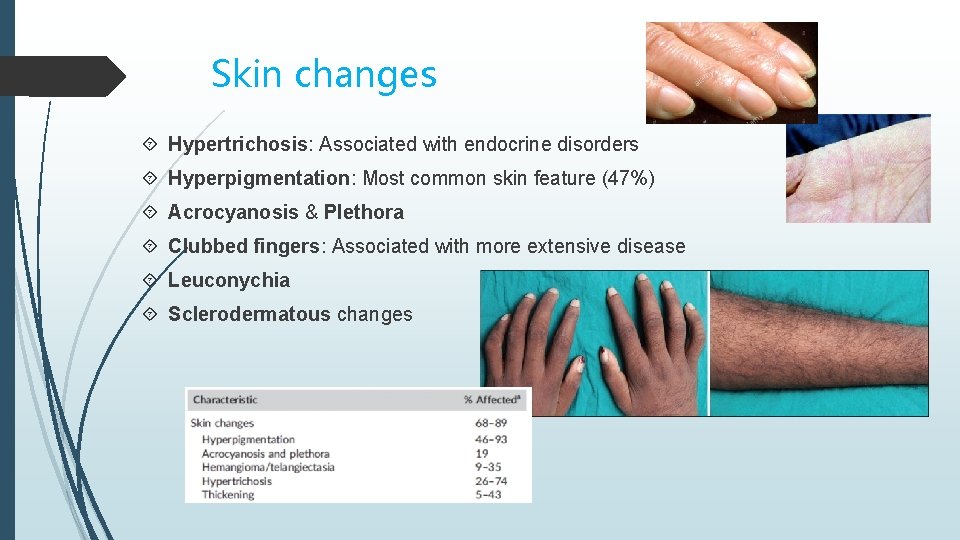 Skin changes Hypertrichosis: Associated with endocrine disorders Hyperpigmentation: Most common skin feature (47%) Acrocyanosis