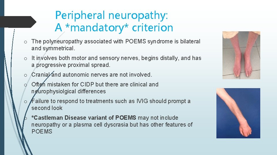 Peripheral neuropathy: A *mandatory* criterion o The polyneuropathy associated with POEMS syndrome is bilateral