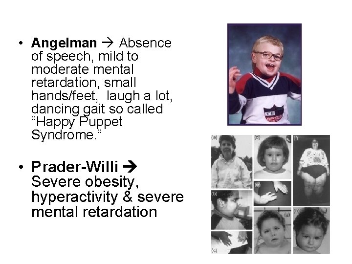  • Angelman Absence of speech, mild to moderate mental retardation, small hands/feet, laugh