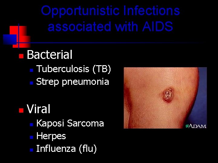 Nick Ureelanah Is Hiv And Aids The Same