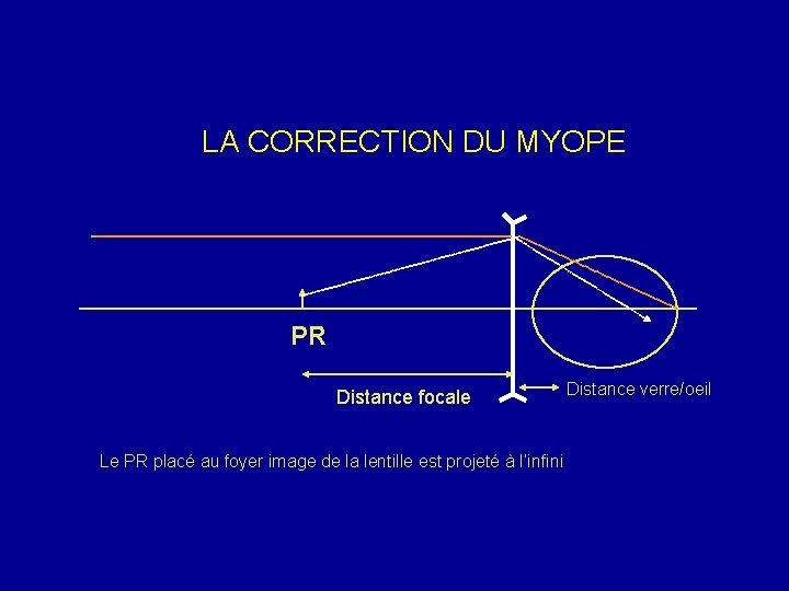 LA CORRECTION DU MYOPE PR Distance focale Le PR placé au foyer image de