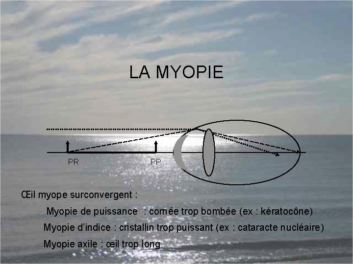 LA MYOPIE PR PP Œil myope surconvergent : Myopie de puissance : cornée trop