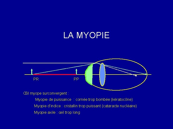 LA MYOPIE PR PP Œil myope surconvergent : Myopie de puissance : cornée trop