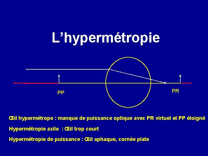 L’hypermétropie PP PR Œil hypermétrope : manque de puissance optique avec PR virtuel et