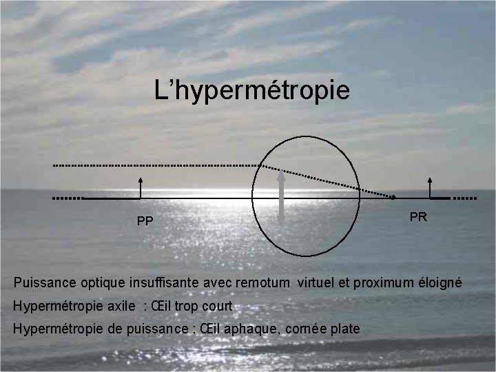 L’hypermétropie PP PR Puissance optique insuffisante avec remotum virtuel et proximum éloigné Hypermétropie axile