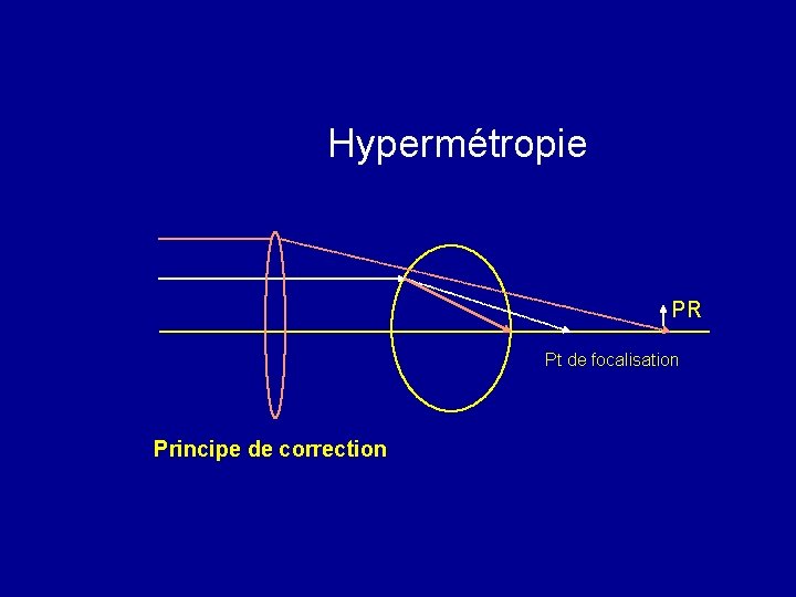 Hypermétropie PR Pt de focalisation Principe de correction 