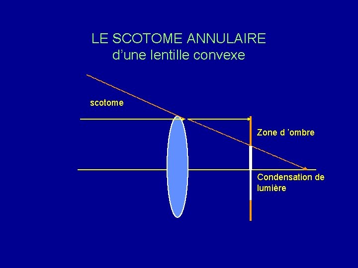 LE SCOTOME ANNULAIRE d’une lentille convexe scotome Zone d ’ombre Condensation de lumière 