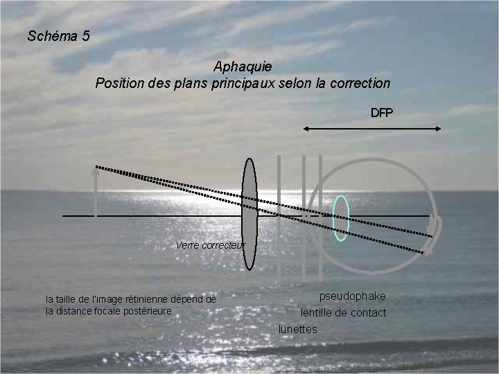 Schéma 5 Aphaquie Position des plans principaux selon la correction DFP Verre correcteur la