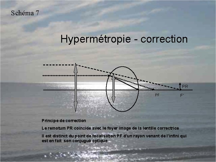 Schéma 7 Hypermétropie - correction PR PF F’ Principe de correction Le remotum PR